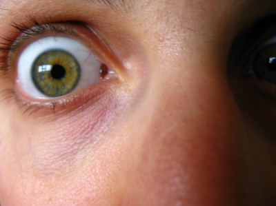 Pigmentförändring/leverfläck i ögat - Cancer?